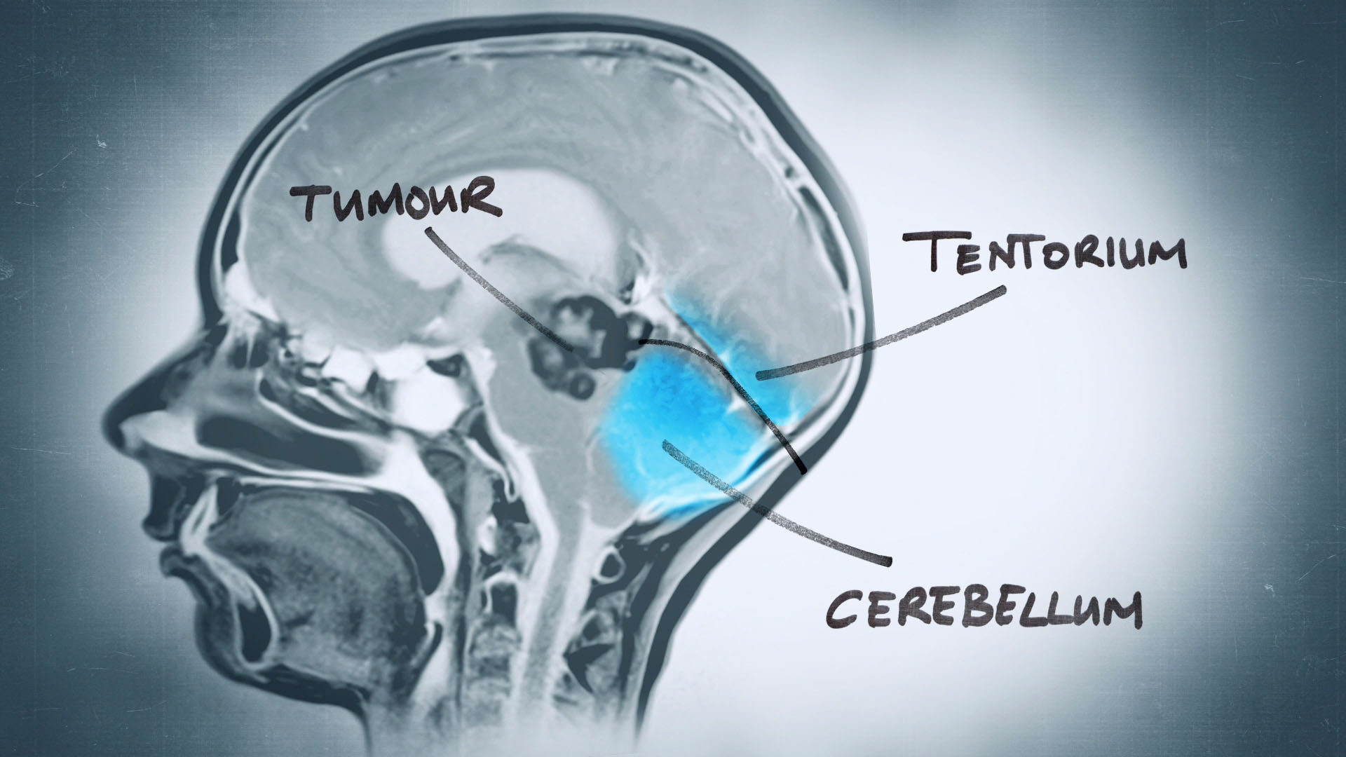 Brain Surgeons: Between Life and Death